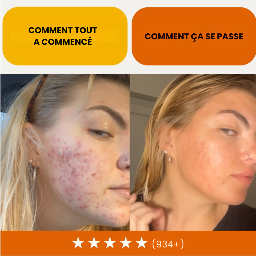 Rituel Anti-Acné 3-en-1